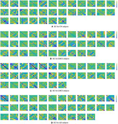 Estimating effective connectivity in Alzheimer's disease progression: A dynamic causal modeling study